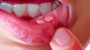 6 Cách trị nhiệt miệng trong 1 ngày