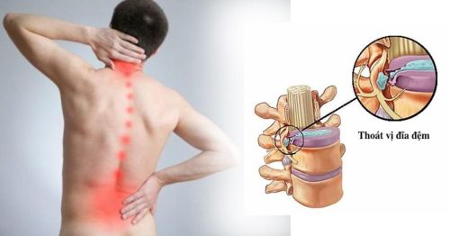 Đau lưng là triệu chứng chính của thoát vị đĩa đệm
